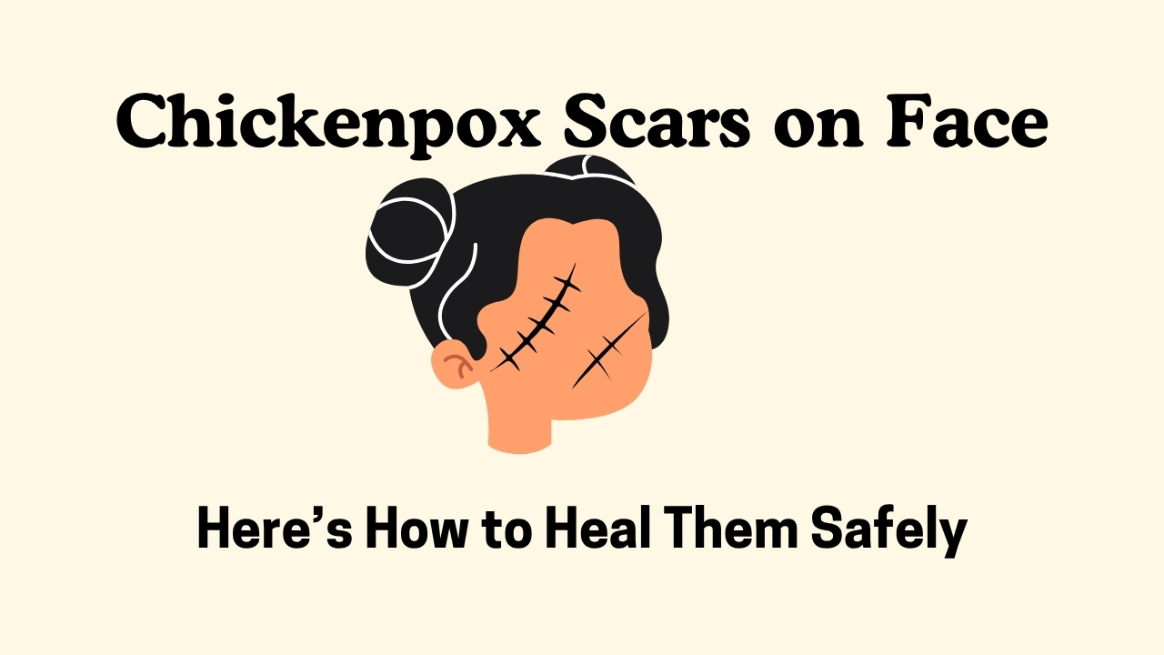 Chickenpox Scars on Face? Here’s How to Heal Them Safely
