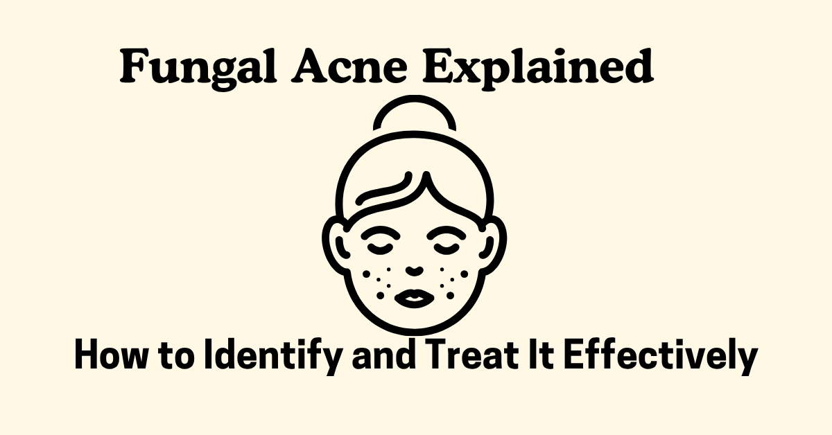 Fungal Acne Explained – How to Identify and Treat It Effectively